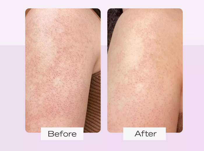 A comparison image of a person's skin before and after using the product, showing visibly reduced redness and a smoother surface.