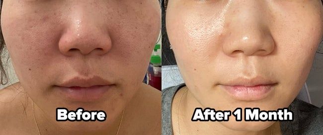 On the left, a reviewer’s skin showing hyperpigmentation on the cheeks, labeled