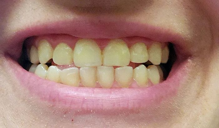 A smile before using the teeth whitening treatment
