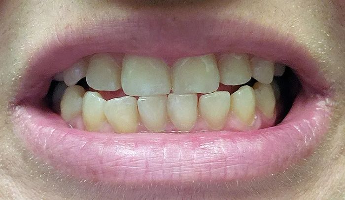 A smile after the teeth whitening treatment, showing noticeable improvements in whiteness