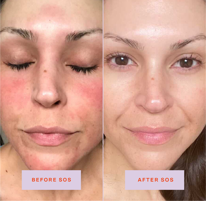 A reviewer showing redness on their cheeks and chin (on the left)