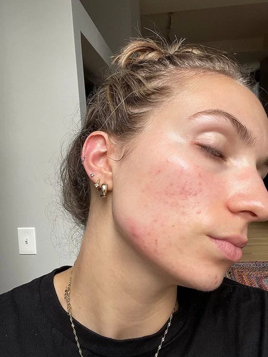 A reviewer showing their face with noticeable red spots before using the balm