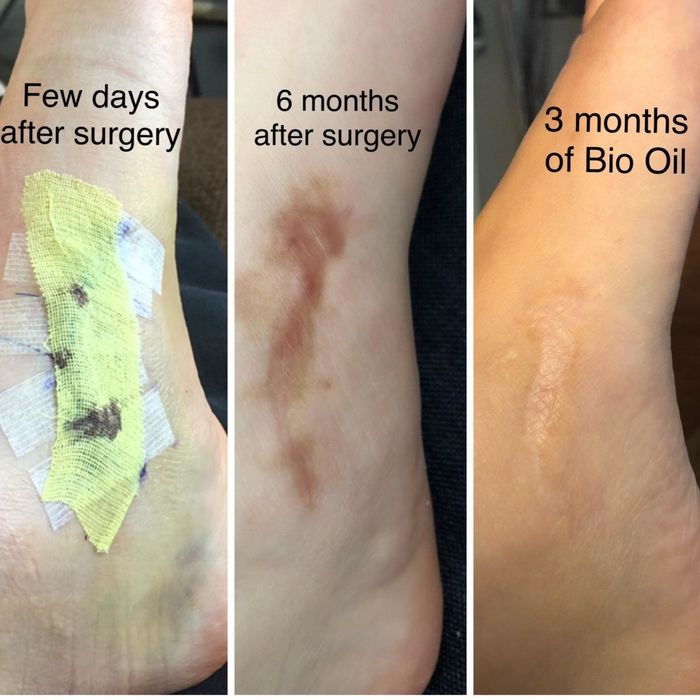 A reviewer shows their scar immediately post-surgery, six months after surgery, and how it has faded after three months of using the oil