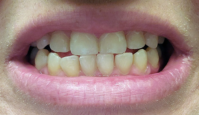 a smile after teeth whitening treatment, showing visible improvements in whiteness