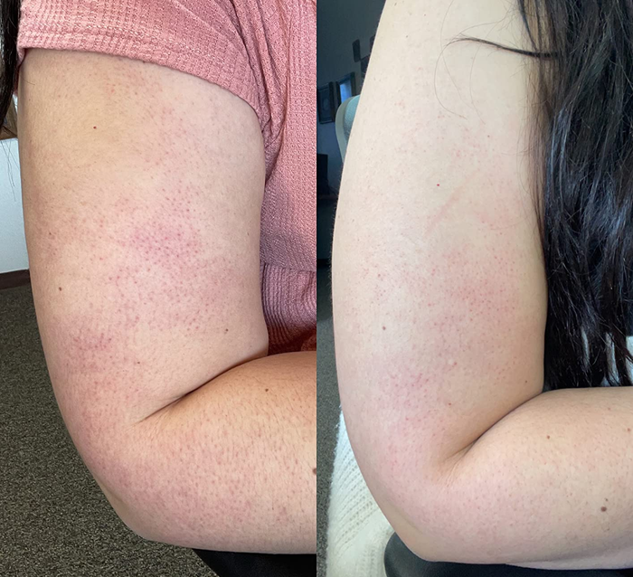 on the left, a reviewer with red bumps on their upper arm and, on the right, the same reviewer with reduced bumps
