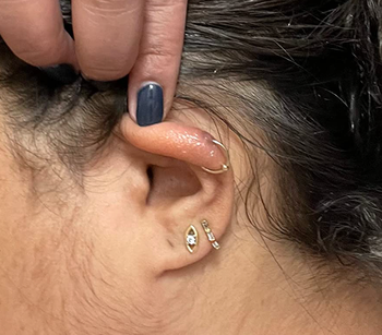 The same reviewer's ear after using the keloid treatment daily, with noticeable improvement