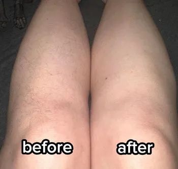 Close-up of two legs, one covered in hair and the other smooth, showcasing the difference after hair removal