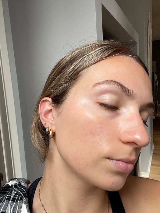 The same reviewer showing their face after using the balm, with red spots visibly reduced