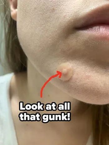 Same reviewer, but now the pimple patch shows a white circle in the center