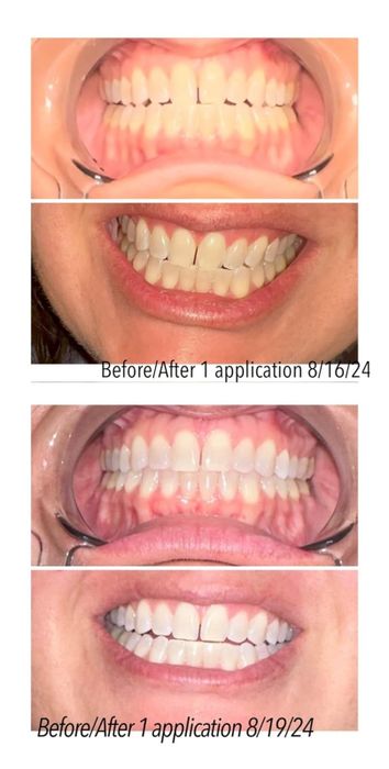Before and after photos documenting the whitening results after one application on 8/16/24 and 8/19/24.