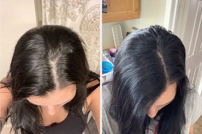 A before-and-after photo of a reviewer’s hairline showing noticeable improvement in thickness and fullness after using the shampoo.