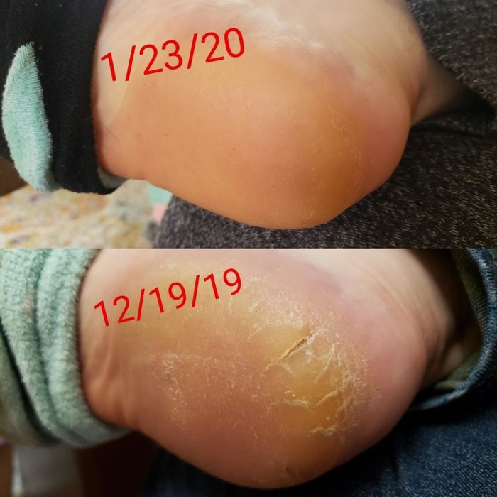 Reviewer’s before and after photos of a cracked heel and a much smoother one, taken about a month apart