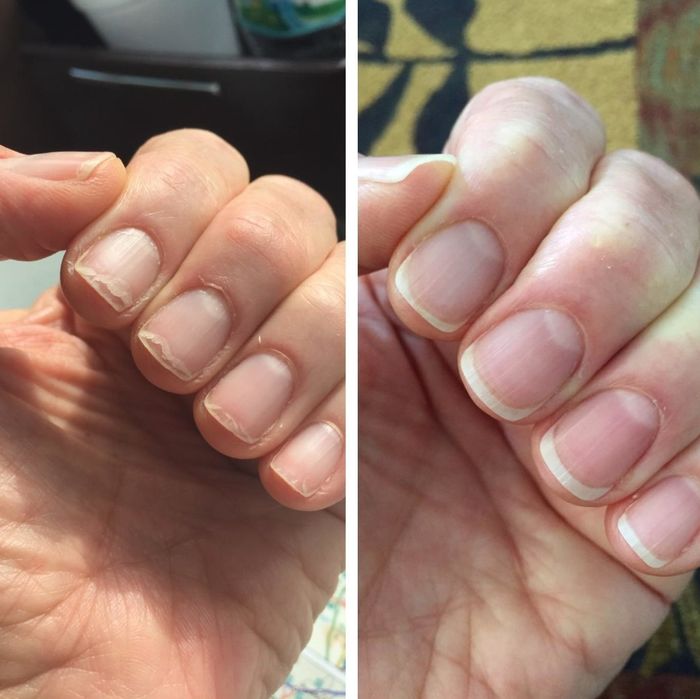 Before-and-after shots of a reviewer's brittle nails compared to their stronger, healthier nails