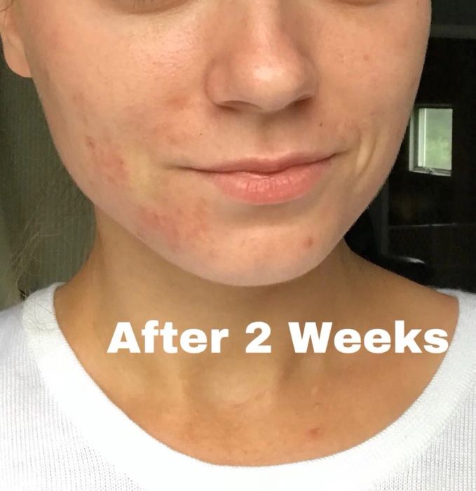 The reviewer's clearer skin after two weeks of using the cream