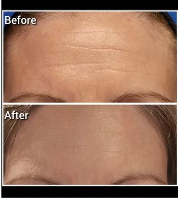 Close-up shot of a person's forehead highlighting the area being treated with a facial mask.