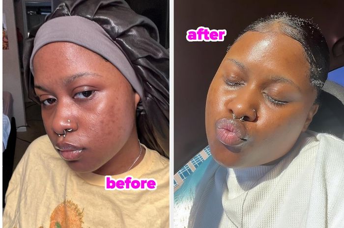 The reviewer showing their skin before and after using the essence.