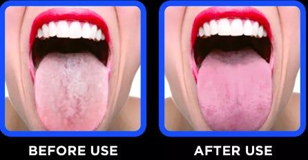 Two close-up images side by side: the left displays the tongue 'Before Use' with a white coating, and the right shows the 'After Use' with a clean, pink tongue.