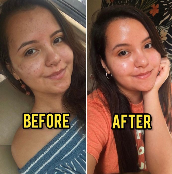 Before-and-after photos of a reviewer showing reduced acne marks and glowing, clearer skin.