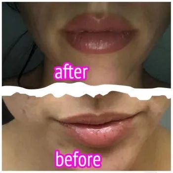 reviewer's lips before and after applying the lip plumper