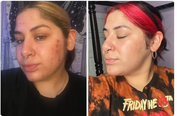 Side-by-side photos showing a person's skin before and after using skincare products, with the left showing visible acne and redness, and the right showing clearer skin.