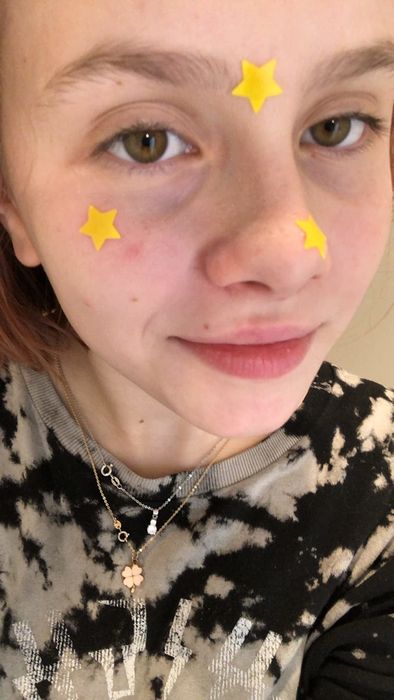 A reviewer wearing three of the star-shaped acne patches on their face