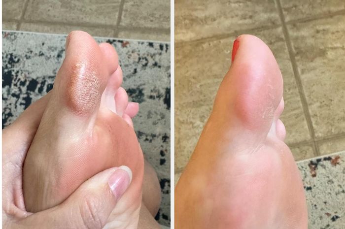 A before-and-after comparison of foot care showing an improvement in skin texture on a toe