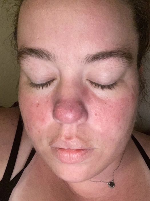 The reviewer's face after applying the calming cream, showing significant improvement with reduced redness and irritation