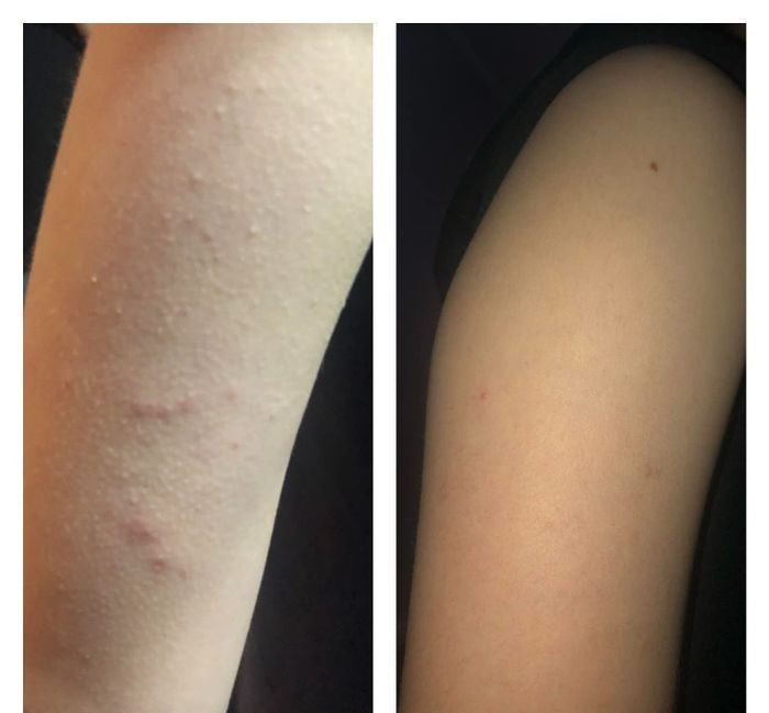 A before and after comparison showing how the body wash completely cleared up the reviewer’s arm bumps and breakouts
