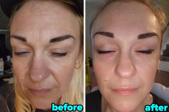 A reviewer’s before and after photos showing noticeable skin smoothness and fewer blemishes