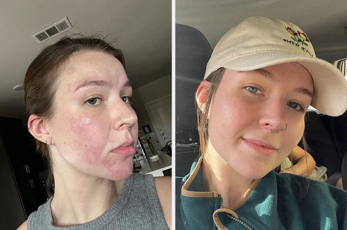 A before-and-after photo of a reviewer, showing redness visibly healed from their face.