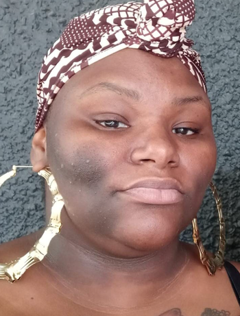 A reviewer before using the dark spot soap bars, showcasing skin with noticeable dark spots.