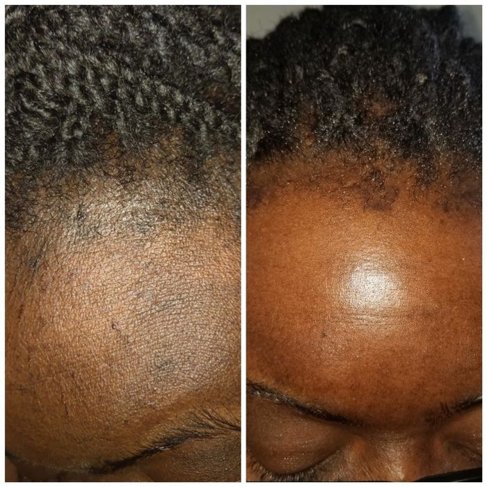 A reviewer with dark skin shows before and after results where the exfoliant lightened dark spots along their hairline, leaving their skin looking brighter and more even.