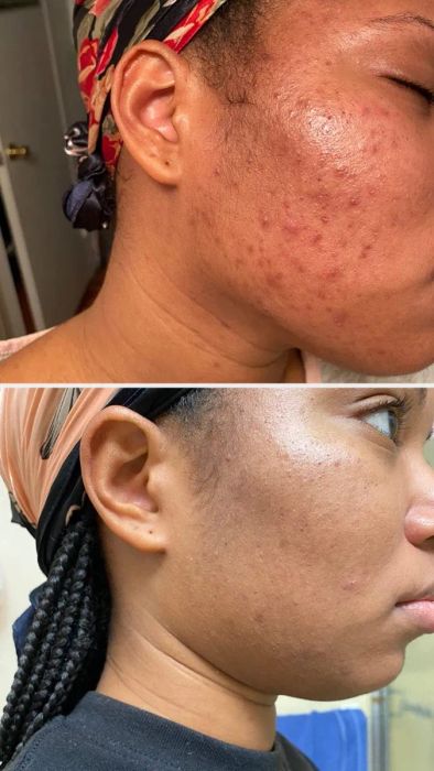 A before and after image showing the impressive results on a reviewer's cheek after using the exfoliant.