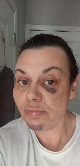A reviewer showing dark marks on their face before using the color corrector.