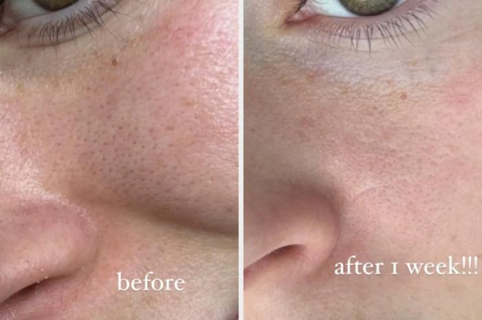 Close-up of a person's cheek showing before and after results of one week of using skincare treatment, with noticeably reduced pores and smoother skin.