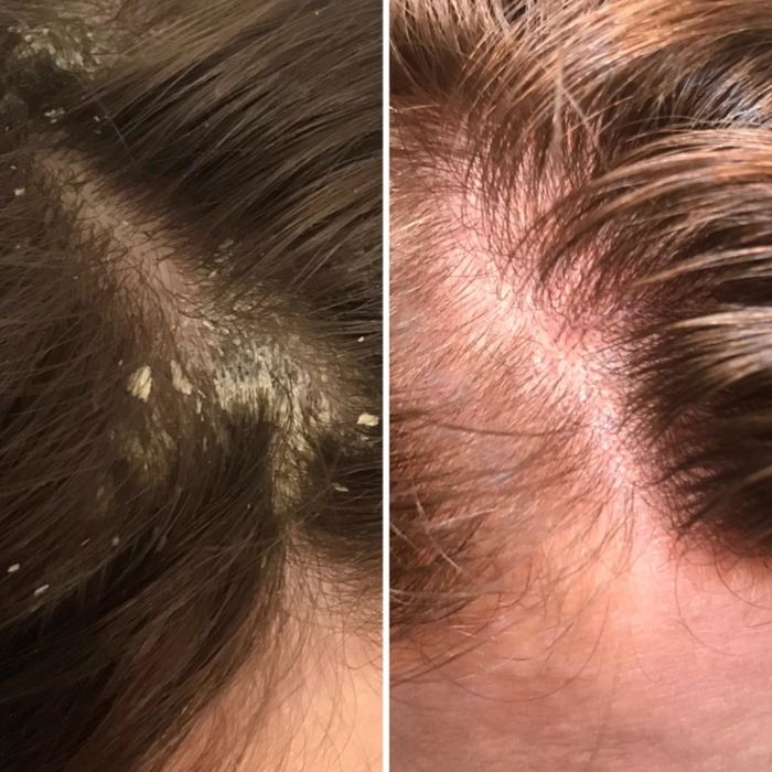 A reviewer's before-and-after showing how the shampoo completely cleared up their stubborn dandruff.