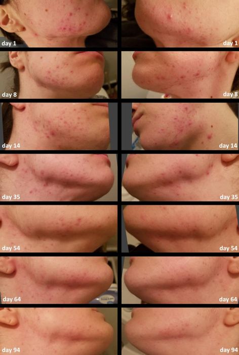 Before and after using the Differin gel for 94 days