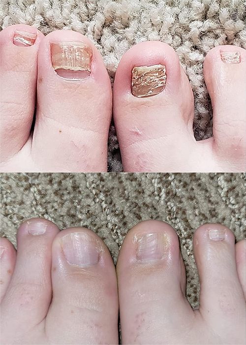 Before and after images showing a reviewer's toenails with fungal infection, followed by a healthy, fungus-free result after using the product