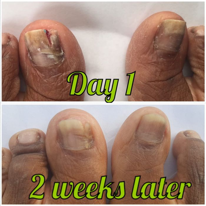 Before and after images of a reviewer’s toenails, first showing fungus, then revealing a clear, healthy nail after treatment