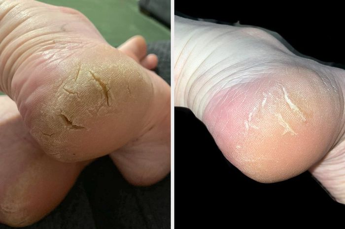 Close-up of two heels side by side, showing before and after results for cracked skin treatment
