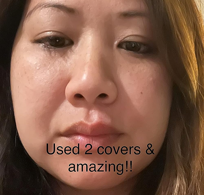 The same reviewer whose cold sore is now barely noticeable and visibly more healed after using just 2 patches