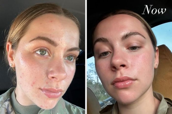 Side-by-side comparison of a woman before and after using skincare products, showing her acne in the left photo and clearer skin in the right photo.