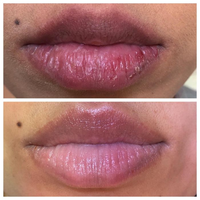 Before photo of a reviewer with dry, cracked lips, and after using the balm, their lips appear moisturized and healthy.