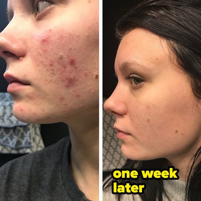 Before and after images of a reviewer with cystic acne showing visible improvement.