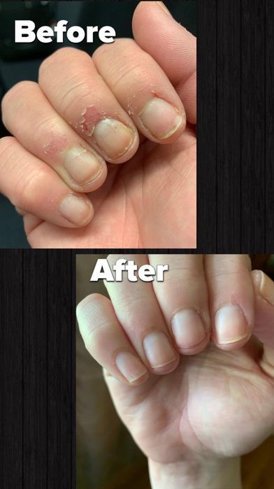 A comparison of the reviewer's nails before using the oil, showing damaged cuticles, and after, with their nails healed and looking nourished.