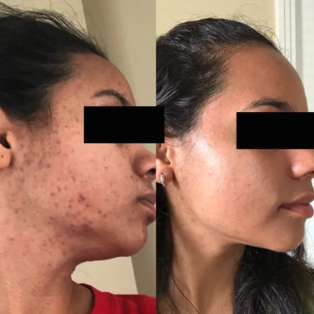 Before-and-after photo of a reviewer showing acne scars fading drastically with clearer skin in the after shot.
