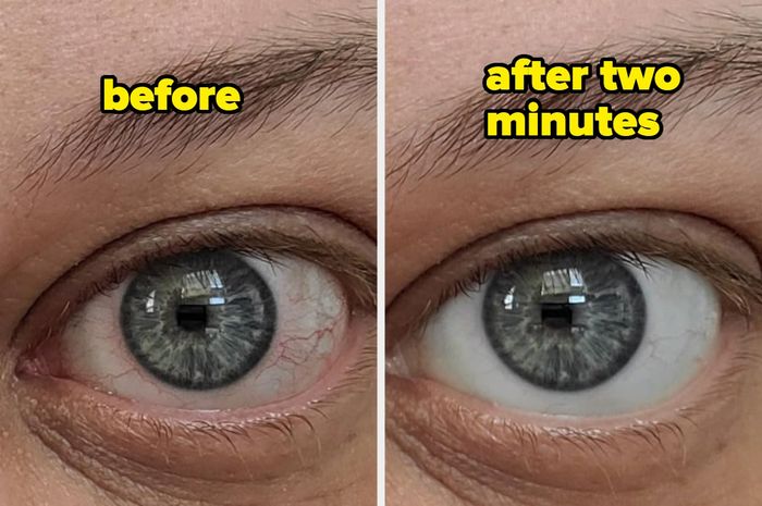 A close-up of a person’s eye before using the product, showing noticeable redness.