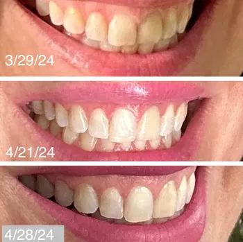 Three close-up smiles showcasing teeth whitening progress from 3/29/24 to 4/28/24.