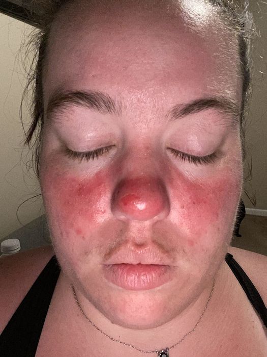 A reviewer with rosacea and dark red patches on their nose and cheeks
