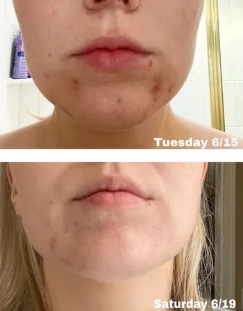 reviewer before treatment showing acne on their chin, and after just 4 days with significantly reduced redness and inflammation